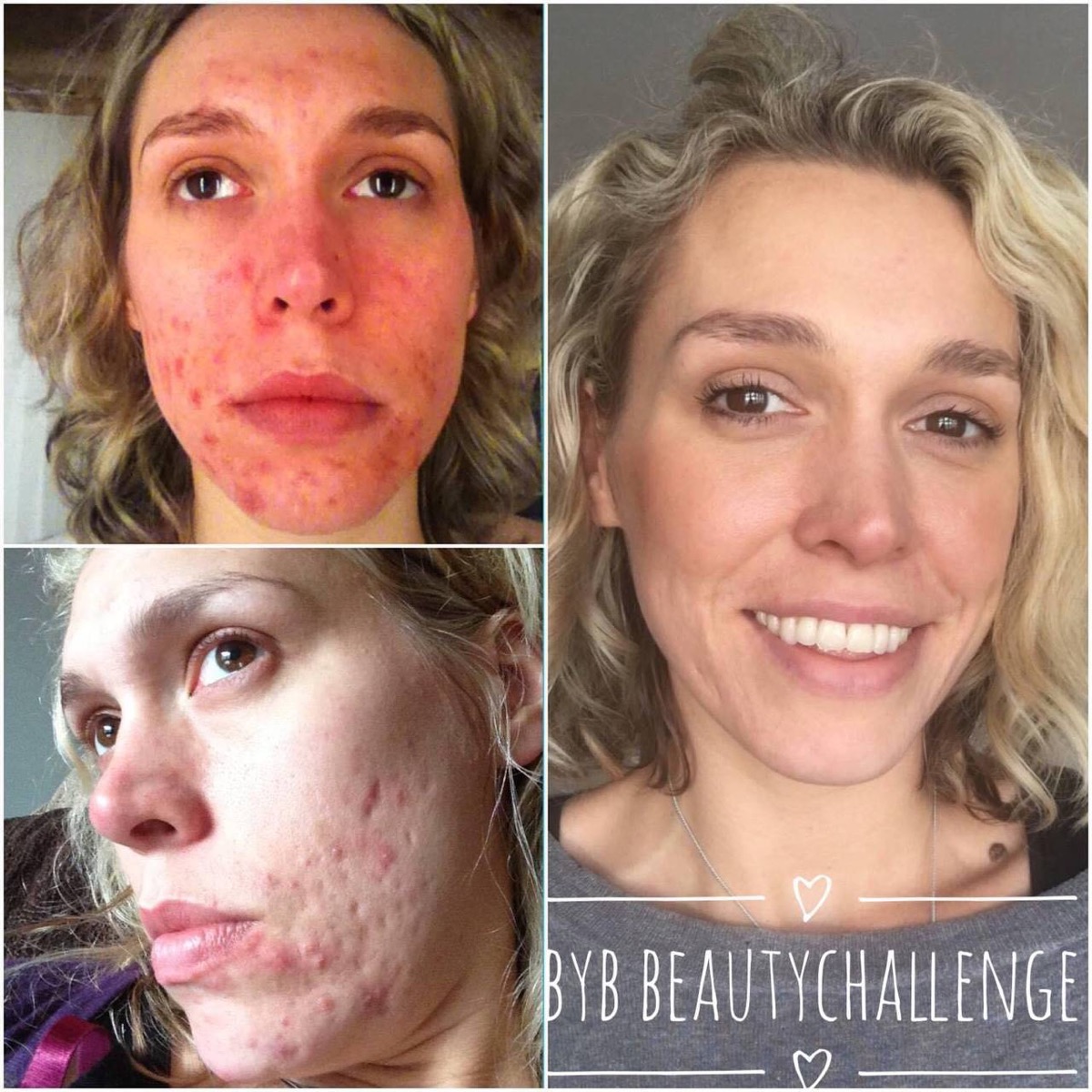 Erfahrungsbericht: Hautbild, BYB Beauty Challenge